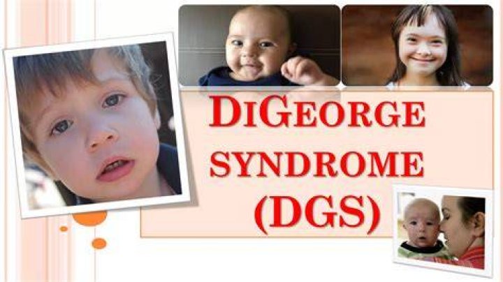 Unveiling The Extraordinary: Celebrities With DiGeorge Syndrome